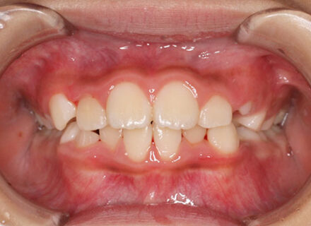 前歯のがたつきを気にされ、小児矯正からの治療を希望