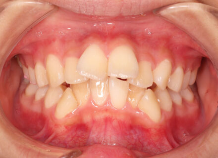 他院からの紹介の患者さん　上下前歯の前方傾斜
