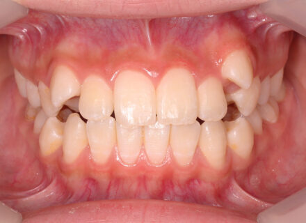 前歯のがたつきと、前歯の前突を気にされ来院