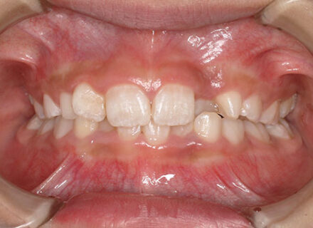 前歯ががたついて生えてきた