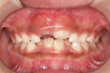 右上の前歯が生えてこない事を気にされ来院