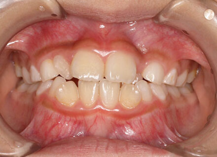 『永久歯の生え方が斜めなのが気になる』 永久歯が大きく、上下顎萌出4前歯に重度の叢生(がたつき)