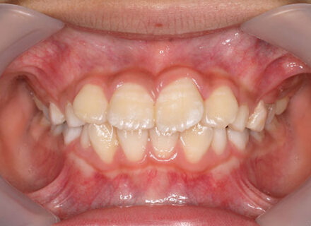 歯が重なっている、出っ歯がを治したい　治療した方からの紹介