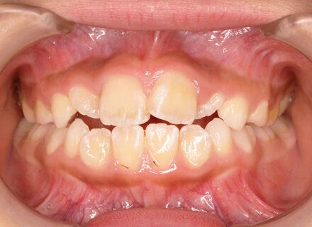 歯科検診でかみ合わせが不良と指摘され、相談来院